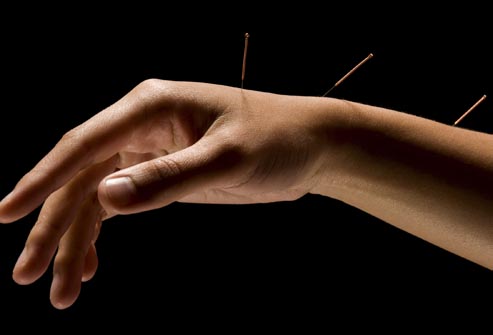 acupuncture treatment Florida - Integrated Medical Center